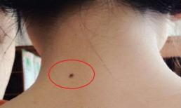 Có ba nốt ruồi này trên cơ thể, cuộc đời có sao tốt chiếu mệnh, công thành danh toại, cuộc sống giàu sang 