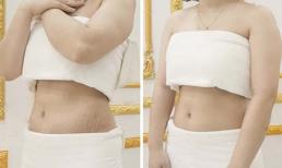 Trị rạn da tại Venus by Asian có tốt không?