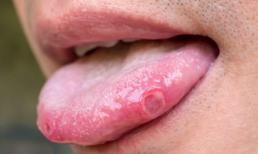 Có ung thư trong cơ thể, lưỡi sẽ 'tiên tri'? 6 hiện tượng này ở lưỡi cho thấy ung thư có thể đã đến 