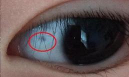 “Đốm đen” trên lòng trắng của mắt trẻ là gì? 4 lý do, cha mẹ không cần quá lo lắng