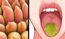 8 cách chữa lành vết bỏng ở lưỡi sau khi ăn đồ cay nóng