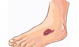 Khi bàn chân kèm theo 4 dấu hiệu bất thường rất có thể bạn đã bị tiểu đường, đừng coi thường nhé!