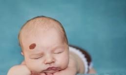 Tiết lộ ý nghĩa vết chàm, vết bớt trên cơ thể dự báo vận số tương lai