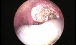 Có bệnh ung thư trong cơ thể, thường có sáu dấu hiệu, nhiều hơn ba dấu hiệu, nhắc nhở: bệnh ung thư đang tiến triển nhanh chóng 