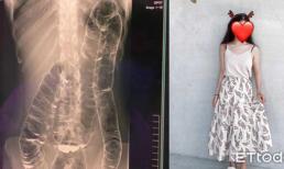 Cô gái không thể đi vệ sinh suốt 17 ngày, khi chụp X-quang mới phát hiện sự thật rùng mình