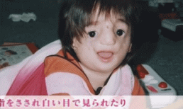 Bé gái sinh ra có gương mặt 'quỹ dữ' khiến nhiều người khiếp sợ nhưng cuộc sống hiện tại như một 'thiên thần' 