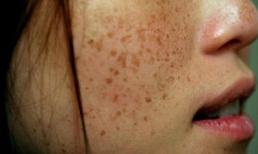 Trả giá bằng cả khuôn mặt khi trị nám da không đúng cách