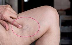 Nếu 4 dấu hiệu bất thường này xảy ra trong giấc ngủ, nó có thể cho thấy cục máu đông đã âm thầm đến 