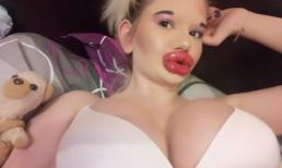 Cô gái từng bơm môi 20 lần để có 'bờ môi khủng nhất thế giới' nay lại phẫu thuật tăng 4 size vòng một