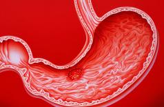 5 loại bệnh dạ dày có thể gây ung thư dạ dày, hãy chú ý 5 dấu hiệu trước khi bệnh nặng hơn, hoặc có thể tránh trước