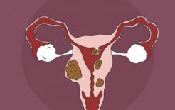 Trên cơ thể phụ nữ có 4 tình trạng này, tử cung đã bị tổn thương nghiêm trọng, hãy cảnh giác với u xơ tử cung tìm đến bạn