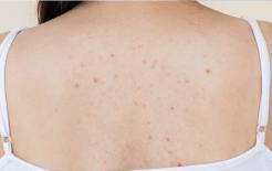 'Hạt kê' mọc trên lưng? Làm thế nào để loại bỏ? Hướng dẫn bạn 2 cách dễ dàng