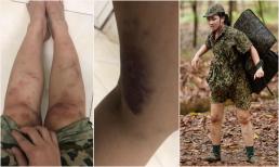 Sau Kỳ Duyên, đến lượt Dương Hoàng Yến đăng cận cảnh đôi chân chi chít vết bầm tím khi tham gia gameshow