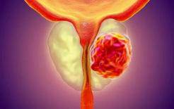 Sau khi đàn ông ngoài 40 tuổi, trong cơ thể xuất hiện 7 dấu hiệu này, ung thư tuyến tiền liệt có thể sẽ tìm đến