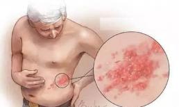 Loại 'đau' này xảy ra thường xuyên vào mùa Xuân, và nó cũng dễ bị di chứng! Phải được xử lý trong vòng 72 giờ