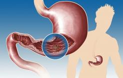 Viêm loét dạ dày nên phòng ngừa như thế nào? Người bị viêm loét dạ dày nên bồi bổ dạ dày ra sao? 