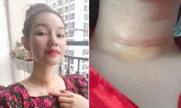 MC Quỳnh Chi phải phẫu thuật khi phát hiện có tế bào ung thư tuyến giáp