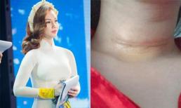 Tình hình sức khỏe của MC Quỳnh Chi sau ca phẫu thuật ung thư tuyến giáp