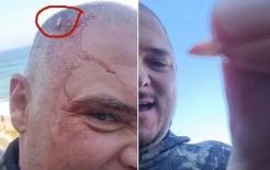 Người đàn ông Nam Phi bị cá mập tấn công, răng cá mập cắm vào đầu 