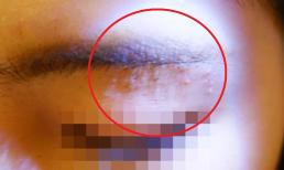 Đi xăm lông mày, cô gái 20 tuổi gặp biến chứng nổi hơn 50 nốt mụn cóc