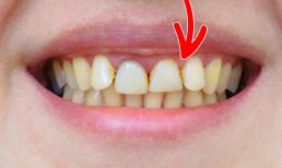 7 thói quen hàng ngày khiến răng bạn bị ố vàng