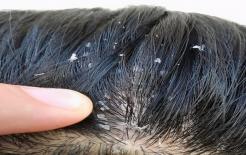 Mẹo giảm tóc dầu: 7 ngày không gội vẫn không lo bết dầu hay ngứa