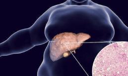 4 biểu hiện khi thức dậy có thể gợi ý đến các vấn đề về gan, nếu không có chứng tỏ gan vẫn tốt