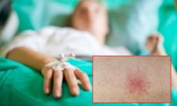 Người phụ nữ 36 tuổi xuất hiện một chấm đỏ nhỏ và được chẩn đoán mắc ung thư gan dù không uống rượu, bia