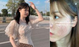 Tình cũ của Quang Hải - Huỳnh Anh gây choáng khi tự đăng ảnh mặt sần sùi, chi chít mụn