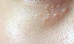 Nếu gương mặt có 3 dấu hiệu này là tín hiệu của mỡ máu cao, đừng quá bất cẩn