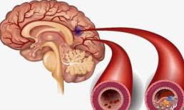 Nếu xảy ra 4 tình huống này sau bữa ăn, dự báo có thể cơn nhồi máu não sắp đến 
