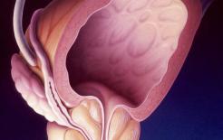 Liệu viêm tuyến tiền liệt có “tự khỏi”? Bác sĩ: Nếu có 3 triệu chứng, tôi khuyên bạn nên đi khám càng sớm càng tốt