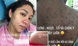 Hoa hậu Đại dương Đặng Thu Thảo khoe ảnh bầu bí 'phát hoảng': Mụn dày đặc trên mặt và lưng, bụng rạn chằng chịt