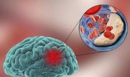 Khi cơn nhồi máu não đến 'gõ cửa', cơ thể sẽ có 3 'mách nước', đừng bỏ qua, hãy kiểm tra càng sớm càng tốt