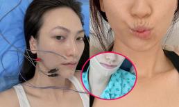 Diễn viên Phương Anh Đào bị lệch méo khung môi sau phẫu thuật u tuyến giáp