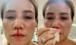 Diễn viên Hoàng Yến lộ khuôn mặt sưng to, bầm tím và máu mũi chảy khiến dân mạng lo lắng
