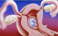 5 biện pháp tránh thai phổ biến, biện pháp thứ 4 là ít gây hại nhất cho phụ nữ và thứ 3 là ít gây hại hơn cho nam giới