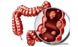 Có ung thư trong cơ thể sẽ 'tiên tri' qua phân! Có 3 'đặc điểm' trong nhà vệ sinh, ung thư đại trực tràng có thể đã ghé thăm 