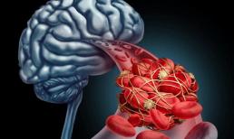 Bác sĩ nhắc nhở: Có 4 thói quen trong đời, nhồi máu não dễ tìm đến bạn hơn, bạn có nằm trong số đó không?