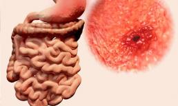 'Thủ phạm' gây ung thư đại trực tràng đã bị phanh phui, 3 thứ này thất thường quá, ruột già khổ sở 