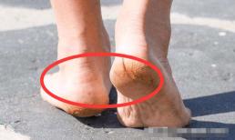 Nếu bàn chân có 'vết' này thì 80% 'ung thư gan', hãy nhanh chóng đi kiểm tra 