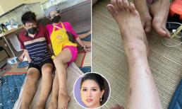 Trang Trần đăng ảnh chân bị ghẻ lở, đáp trả anti-fan vì bị đồn ăn chặn tiền từ thiện