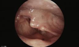 Khàn tiếng lâu ngày là tín hiệu của bệnh ung thư thanh quản, 4 triệu chứng này cần chú ý