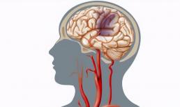 Thủ phạm của việc cung cấp máu không đủ cho não