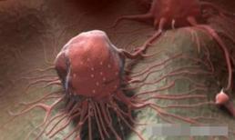 Nếu có 5 'đặc điểm' ở bụng thì 80% trong số đó đã là 'ung thư' rồi