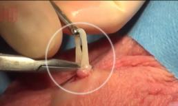 Hóa ra thắt ống dẫn tinh là như thế này! 