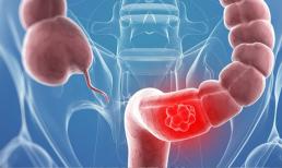 Ung thư trực tràng đã ở giai đoạn nặng ngay khi phát hiện, các bác sĩ nhắc nhở, những người mắc bệnh ung thư ruột thường có 5 điểm chung