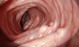 Muốn sống lâu thì trước hết hãy “sống ruột”! Nhắc nhở: Đối với sức khỏe đường ruột, hãy ăn ít hơn 3 thứ và làm ít hơn 3 thứ