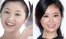 So sánh sao trước và sau khi phẫu thuật răng, xem xong bạn sẽ biết hàm răng quan trọng như thế nào