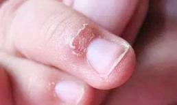 Trẻ thường bị tróc da đầu ngón tay, đó có thể không phải thiếu vitamin mà là một lời nhắc nhở về điều này